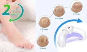 Welnax BioClear Toenail Fungus Device Benefits